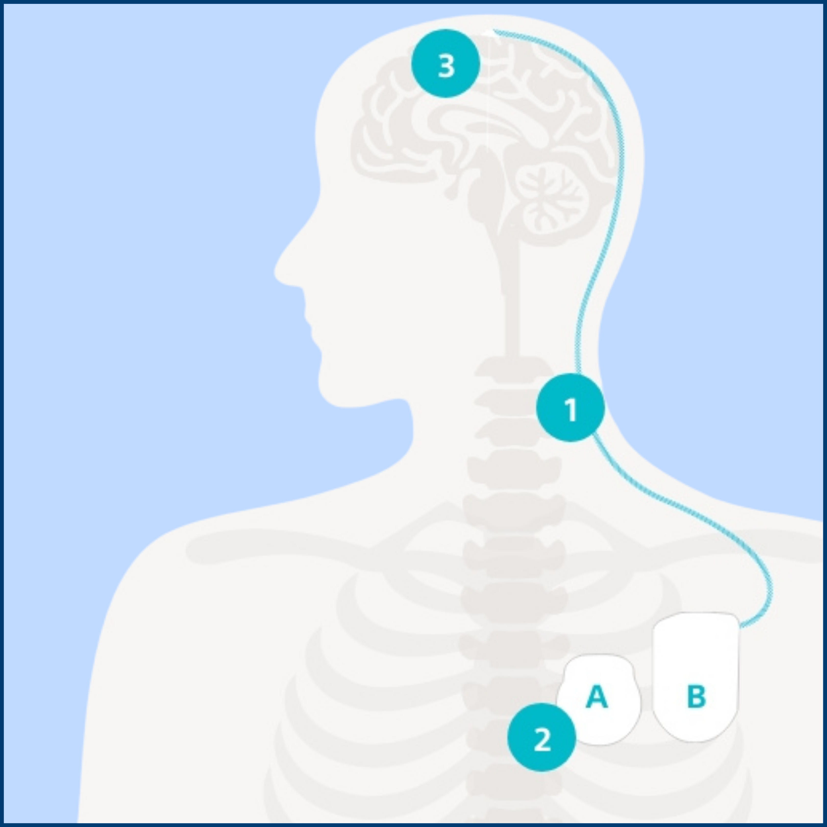 Illustration on the topic of deep brain stimulation (DBS): a torso and the connection between brain and brain pacemaker