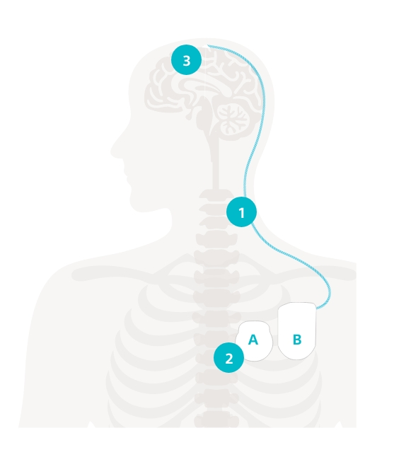 Illustration on the topic of deep brain stimulation (DBS): a torso and the connection between brain and brain pacemaker